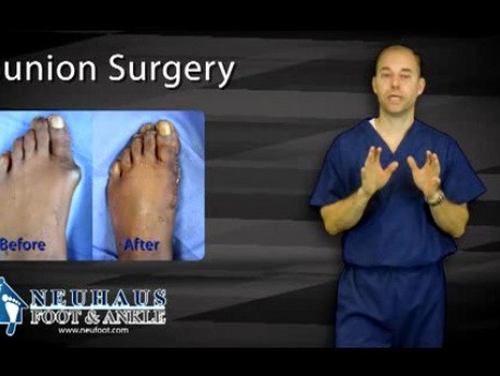 What to Expect with Bunion Surgery