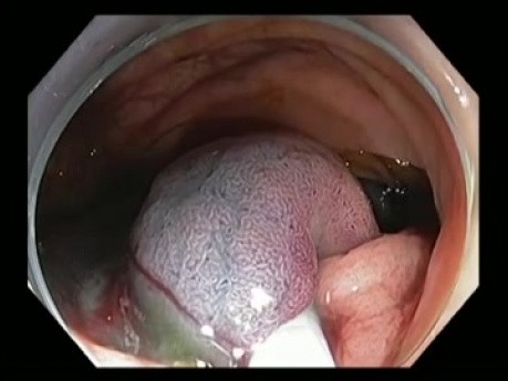 Colonoscopy Gone Awry - Asc Col EMR Bleeding - Case 1A