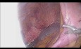 Intracorporeal Anastomosis in Laparoscopic Right Hemicolectomy