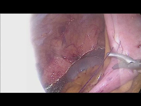 Intracorporeal Anastomosis in Laparoscopic Right Hemicolectomy