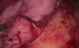 Sleeve Gastrectomy Bleeding Control