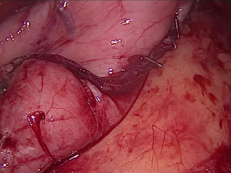 Sleeve Gastrectomy Bleeding Control