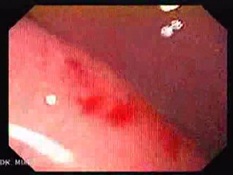 Esophageal Varices - Endoscopy (2 of 5)
