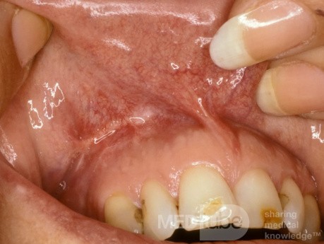 Healed Caldwell Luc Incision