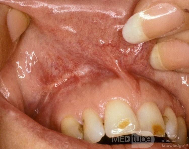 Healed Caldwell Luc Incision