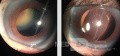 Dislocated Hard Cataract