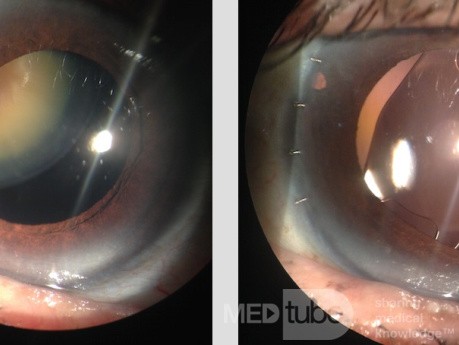 Dislocated Hard Cataract
