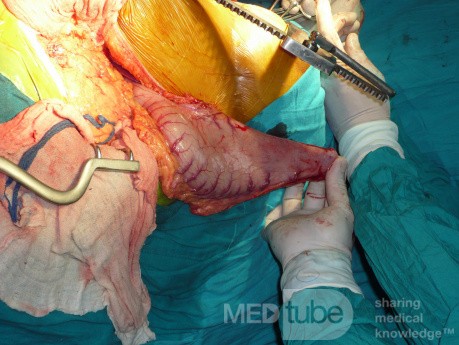 Adenocarcinoma of the cardias and gastric fundus with signet-ring cells (5 of 25)