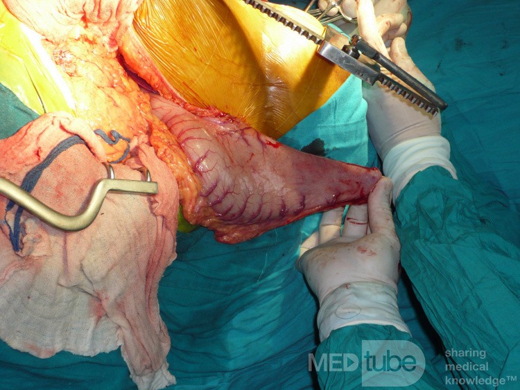 Adenocarcinoma of the cardias and gastric fundus with signet-ring cells (5 of 25)