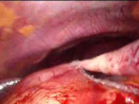 Gastrointestinal Stromal Tumor - GIST (48 of 65)