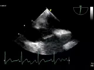 Atrial Septum Aneurysm