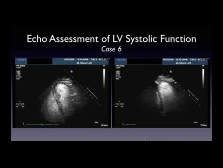 A Practical Approach to Left Ventricular Ejection Fraction (LVEF) by Echocardiography