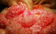 Patient with Pneumatosis Intastinalis