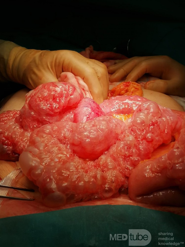 Patient with Pneumatosis Intastinalis