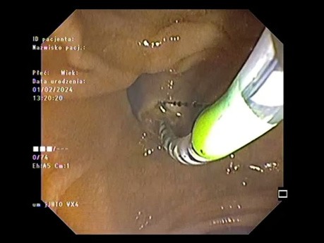 Multiple Stone CBD ERCP Clearance