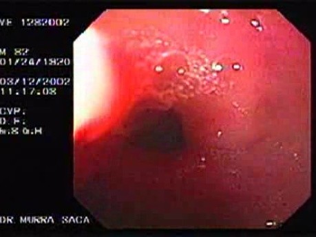 Hyperplastic Gastric Polyp (3 of 3)