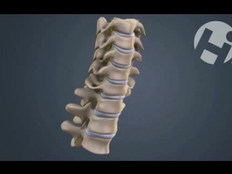 Volumated C7-T1 Subluxation Fracture