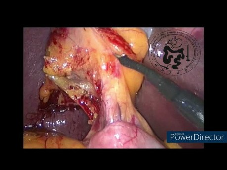Left-sided Gallbladder