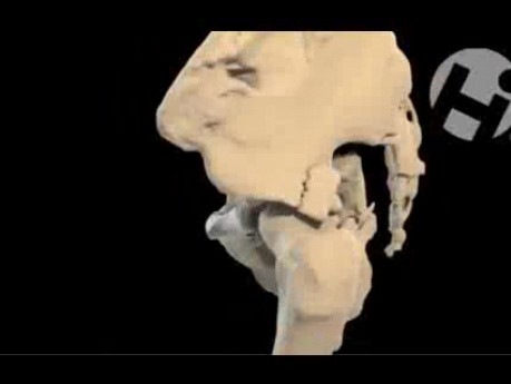 Volumated Pelvic Fractures