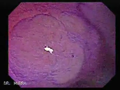 Flat Adenoma (2 of 3)