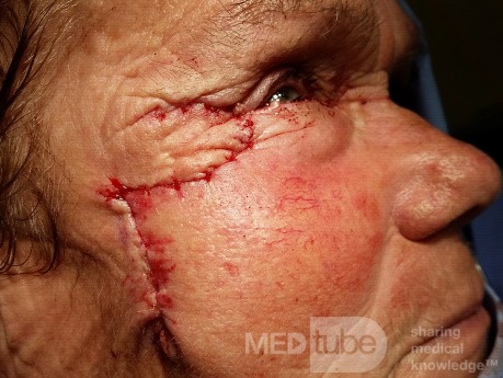Basal Cell Carcinoma (4)