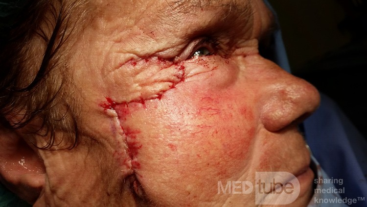 Basal Cell Carcinoma (4)