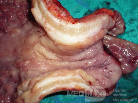 Endoscopy of Scirrhous Gastric Carcinoma involving the entire Fundus, Body and the Antrum (32 of 47)