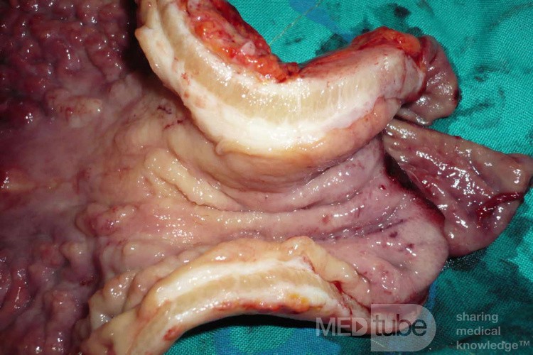 Endoscopy of Scirrhous Gastric Carcinoma involving the entire Fundus, Body and the Antrum (32 of 47)