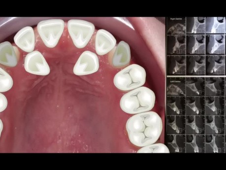 Orthodontic Case Report for Palatally Impacted Canines Traction