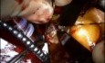 Minimally Invasive Aortic Valve Replacement Surgery and Septal Myectomy