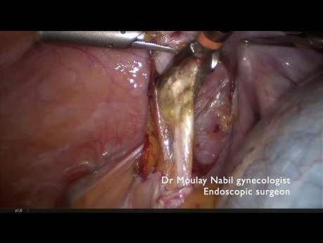 Huge Ovarian Cyst and Early Pregnancy Management