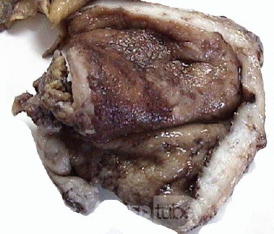 Plastic Linitis with bilateral Krukenberg´s tumor (12 of 13)