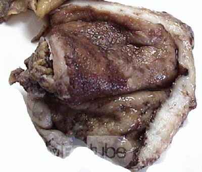 Plastic Linitis with bilateral Krukenberg´s tumor (12 of 13)