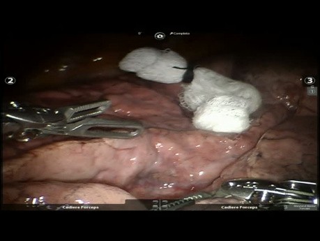 Video Case: Lung Cancer - Easy Robotic Left Upper Lobectomy
