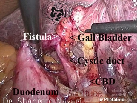 Cholecystoduodenal Fistula