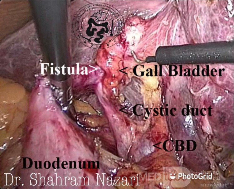 Cholecystoduodenal Fistula