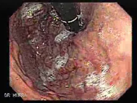 Gastric Varices Rosettes Formation (16 of 22)