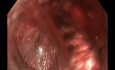 Sessile Polyp Removal