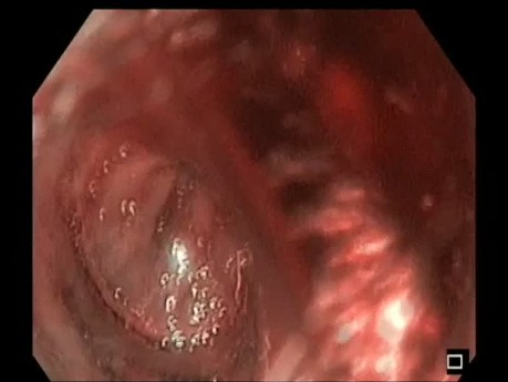 Sessile Polyp Removal