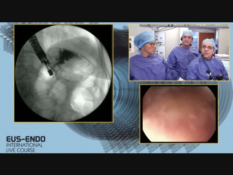 EUS Guided Biliary Stone Extraction