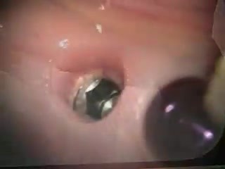 Implant Repair, Lower Right