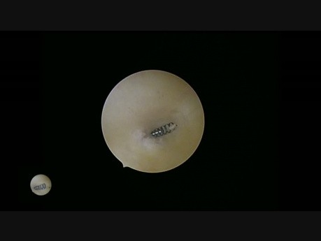 Essure Sterilisation & Endometrial Ablation
