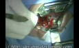 Tonsillectomy by Dissection Method