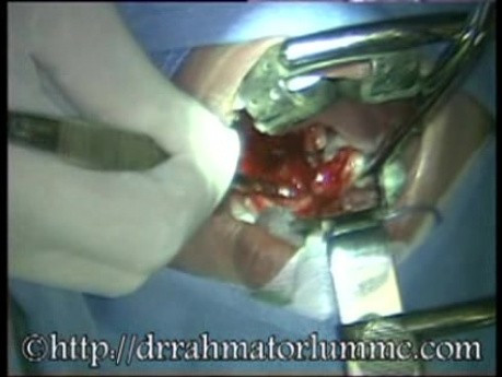 Tonsillectomy by Dissection Method