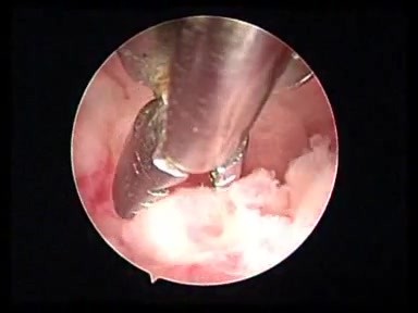 Hysteroscopic biopsy and endometrial vaporization