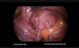 Laparoscopic Appendicectomy 