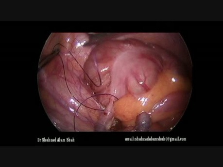 Laparoscopic Appendicectomy 