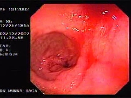 Duodenal Ulcer and Bleeding (1 of 4)