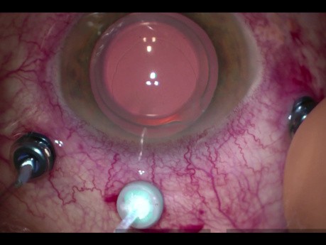Amniotic Membrane Graft Surgery for Persistent Macular Hole