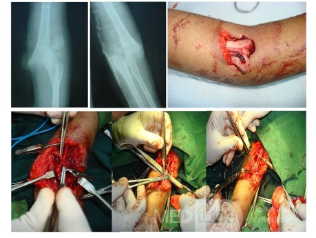 Compound SC# of Humerous with neurovascular injury